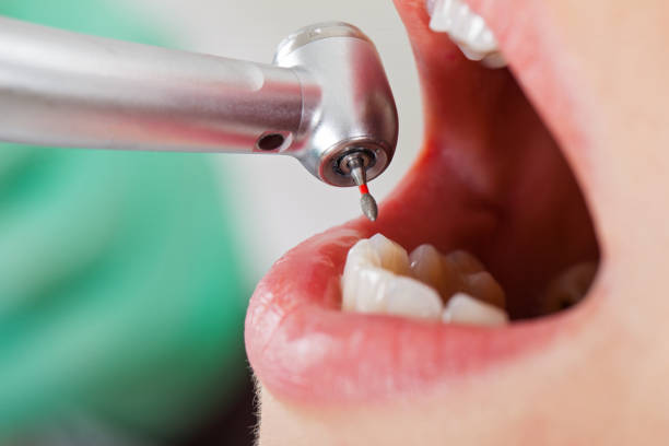 Emergency Dental Filling Replacement in CA